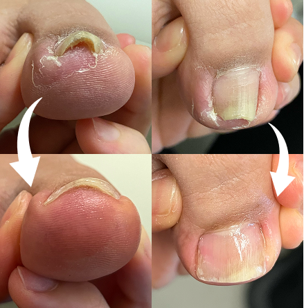 巻き爪施術のビフォーアフター